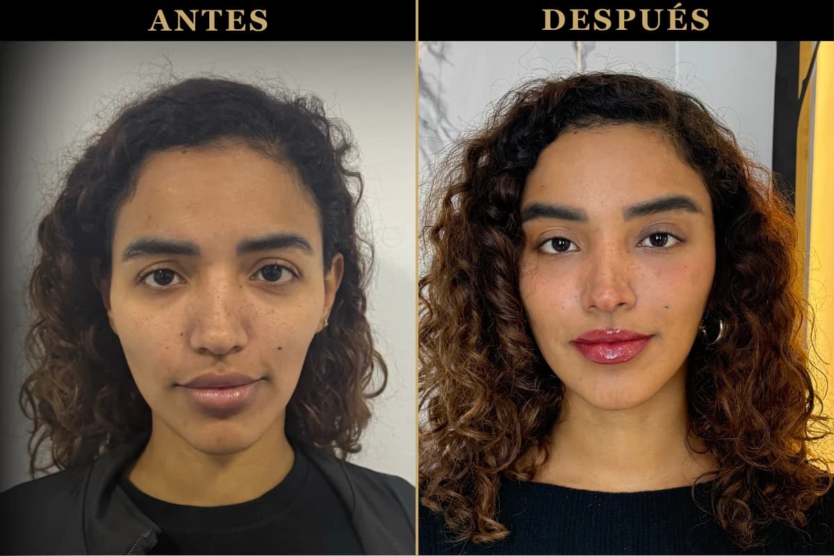 Antes y después de Foxy Eyes endoscópico realizado por el Dr. Freddy Castillo en Lima