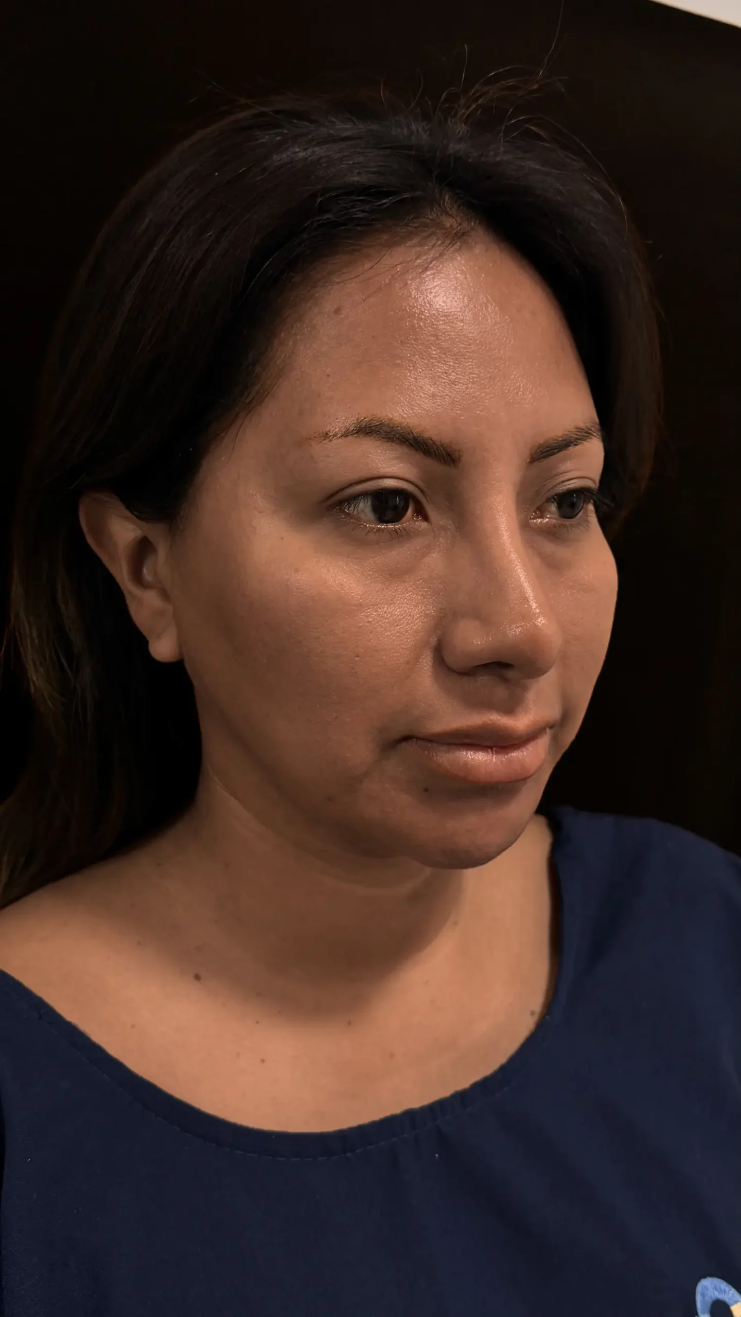 Paciente antes del lifting facial endoscópico realizado por el Dr. Freddy Castillo en Lima