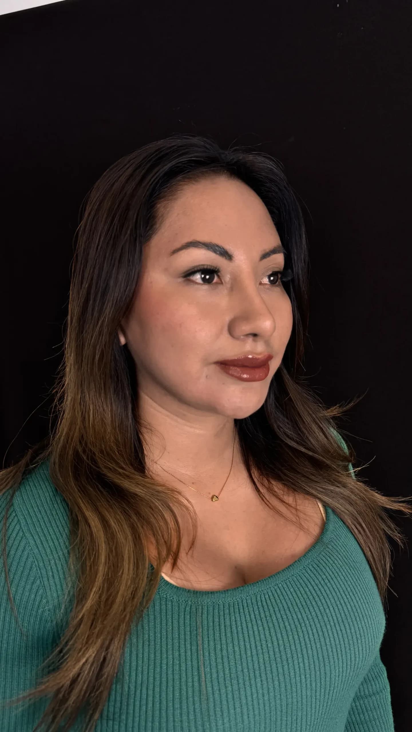 Paciente después del lifting facial endoscópico realizado por el Dr. Freddy Castillo en Lima
