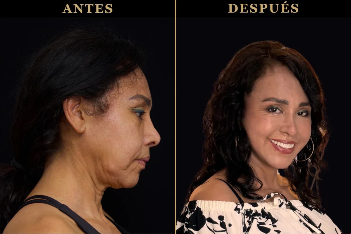 Resultado de lifting Deep Plane antes y después del procedimiento facial
