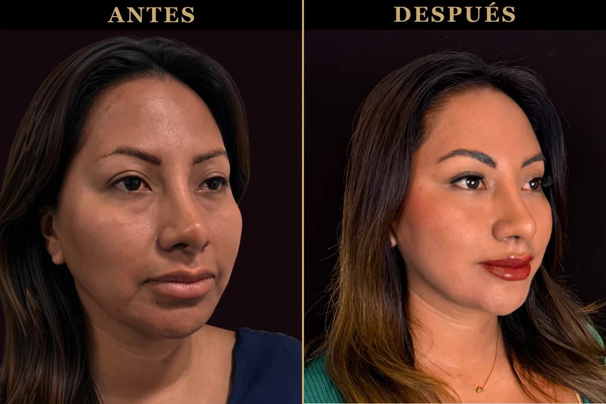 Resultado de lifting facial endoscópico antes y después del procedimiento