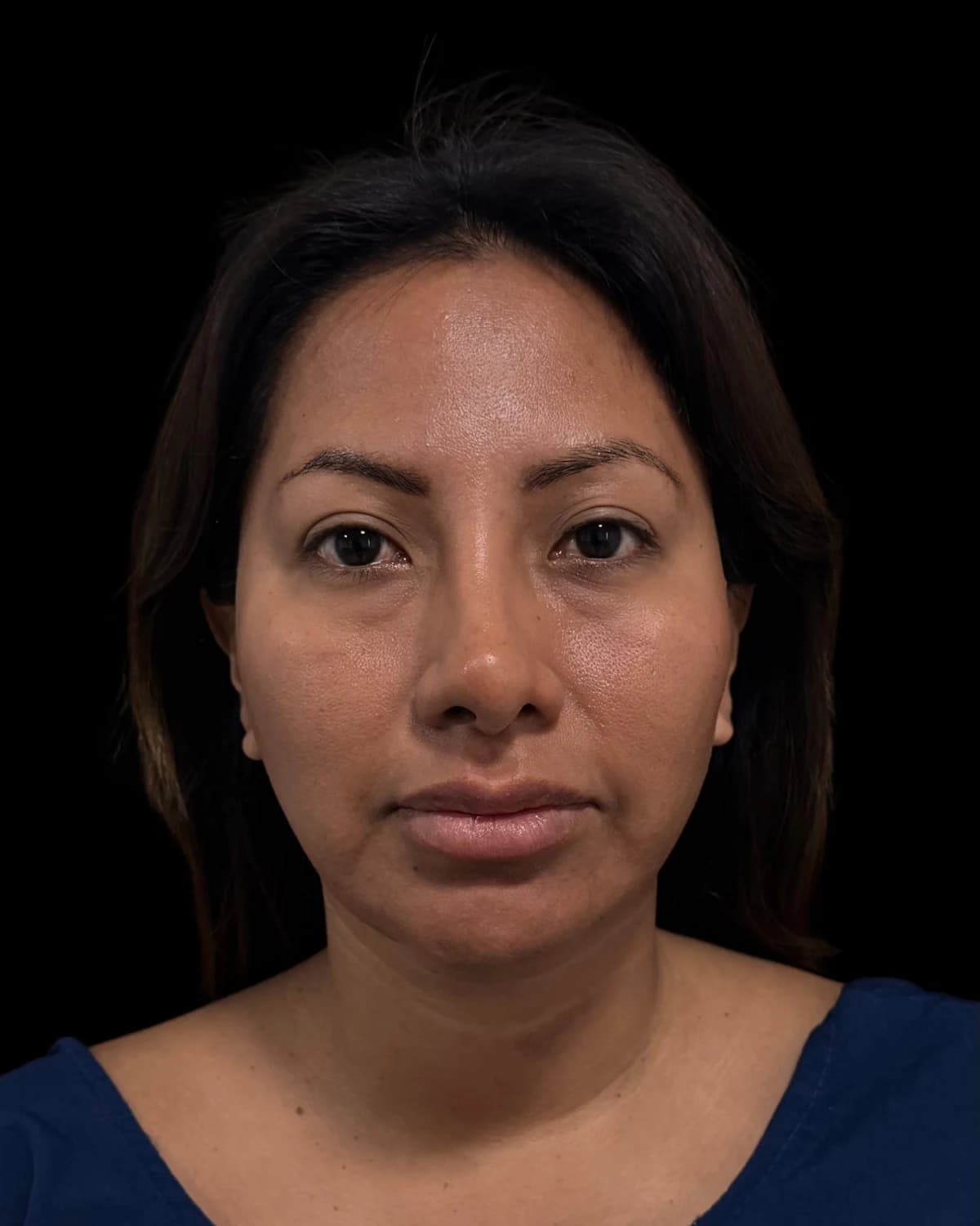 Front view of a patient before the endoscopic facelift, wearing a blue blouse on a black background