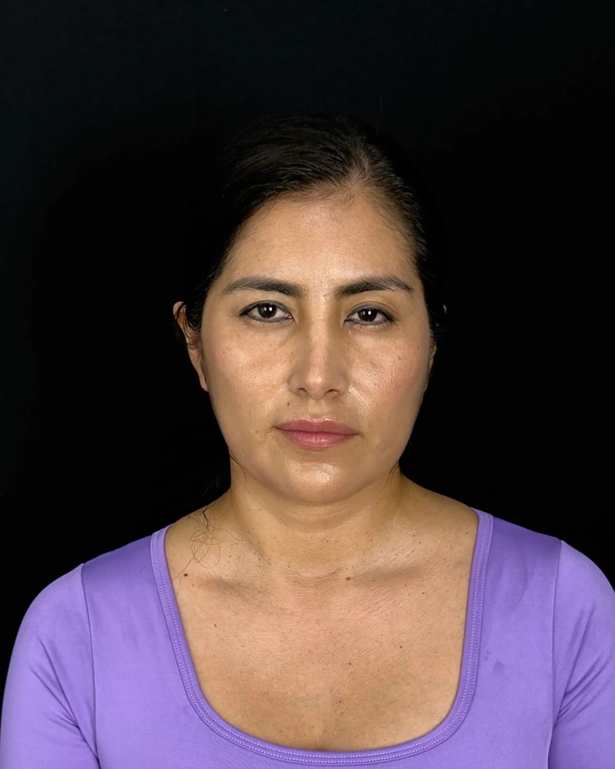 Front view of a patient before the endoscopic facelift, wearing a purple blouse on a dark background