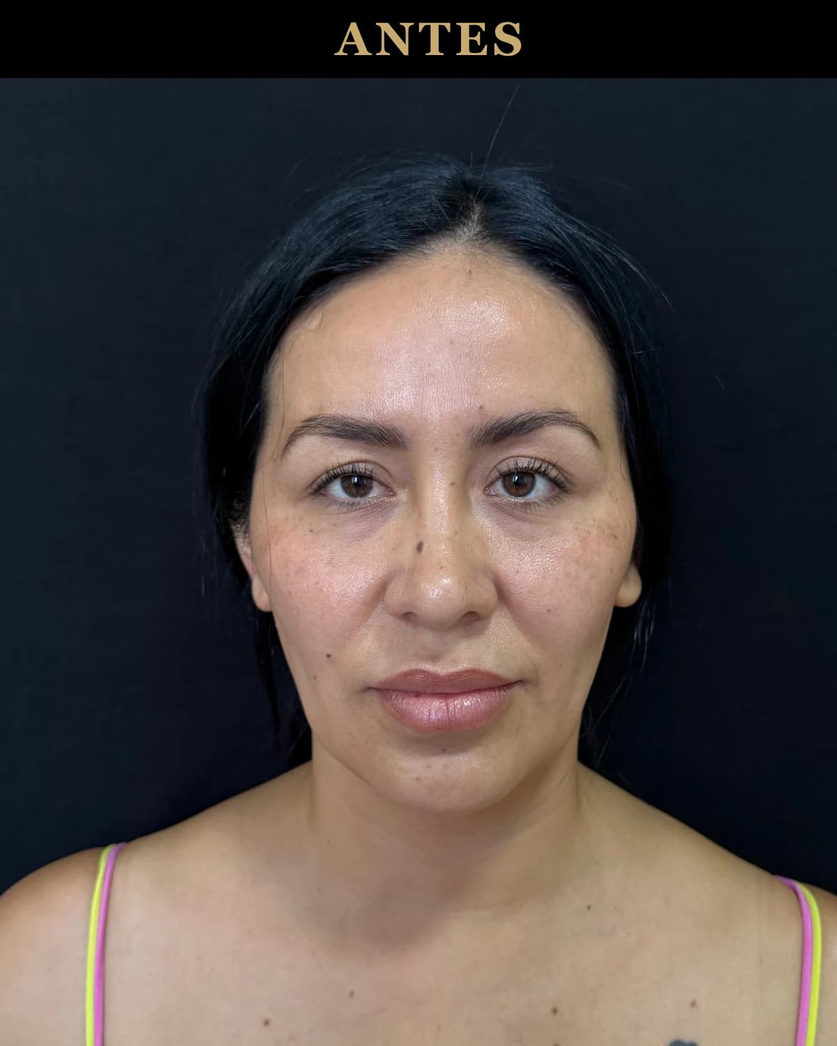 Front view of a patient before the endoscopic facelift, first photograph in the progress sequence