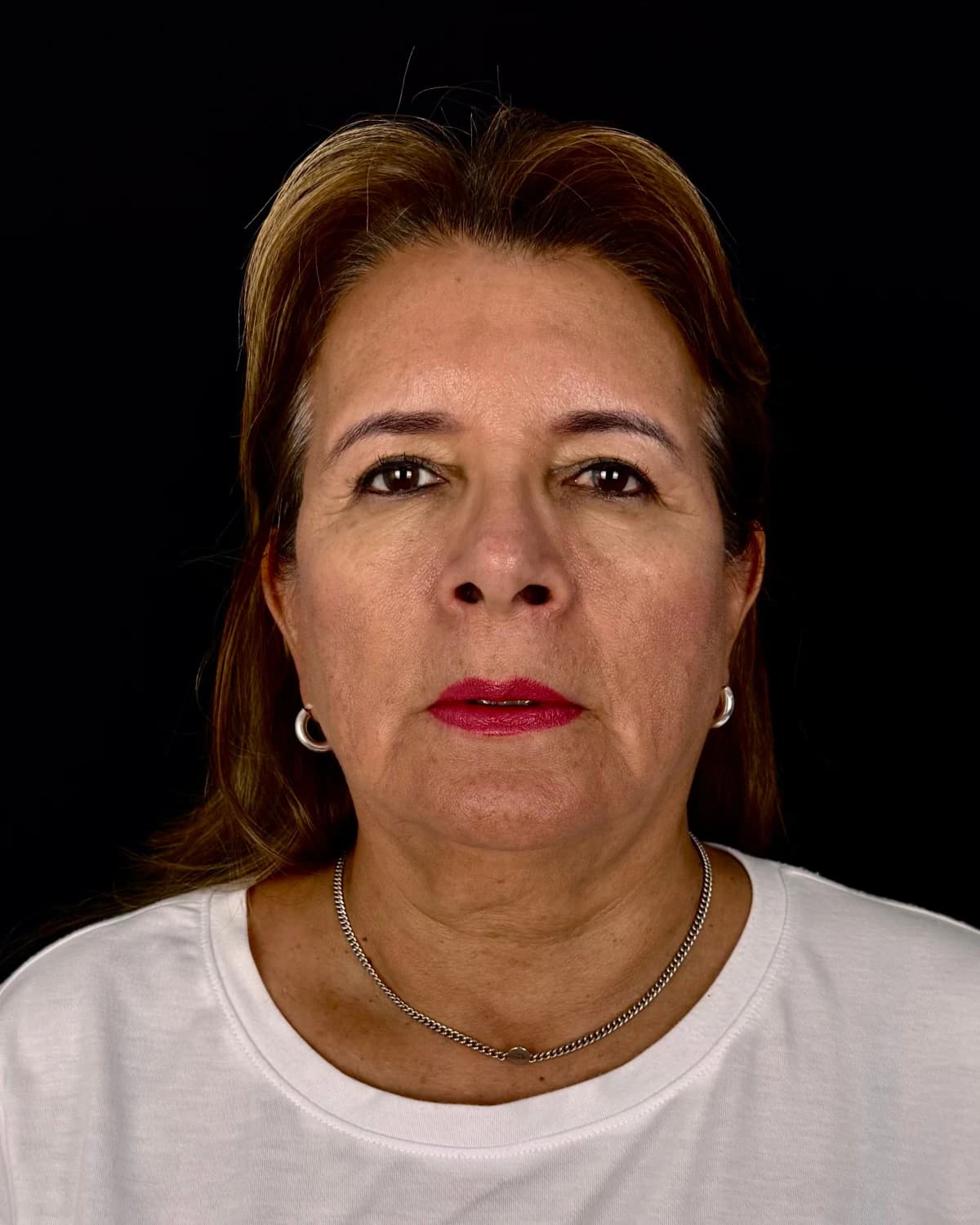 Clinical front-view photograph of a patient before the deep plane facelift, on a dark background