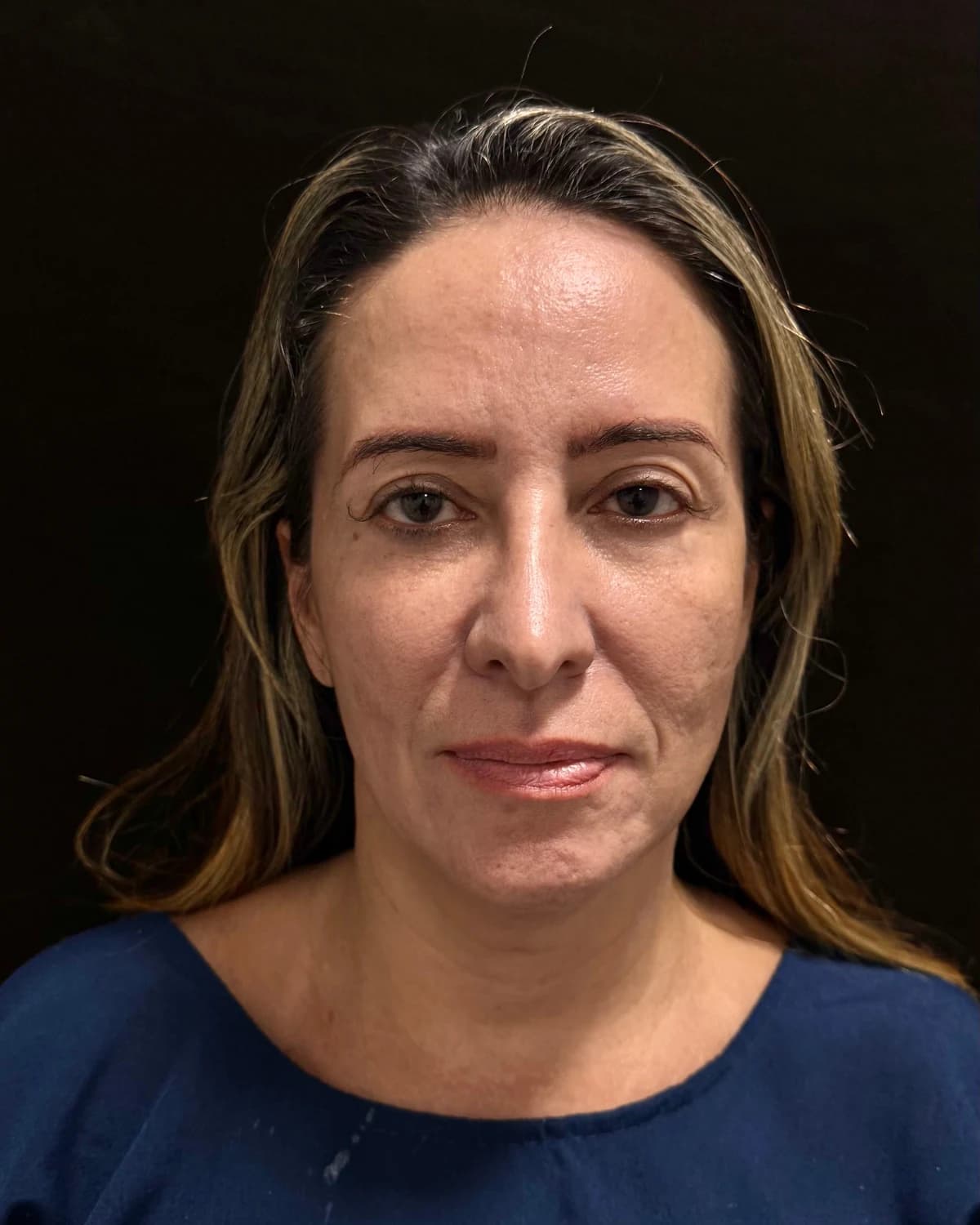 Clinical front-view photograph of a patient before the deep plane facelift, on a dark background, case 5