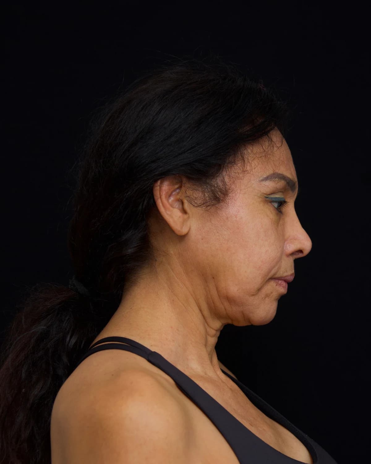 Clinical profile photograph of a patient before the deep plane facelift, wearing a black top on a dark background