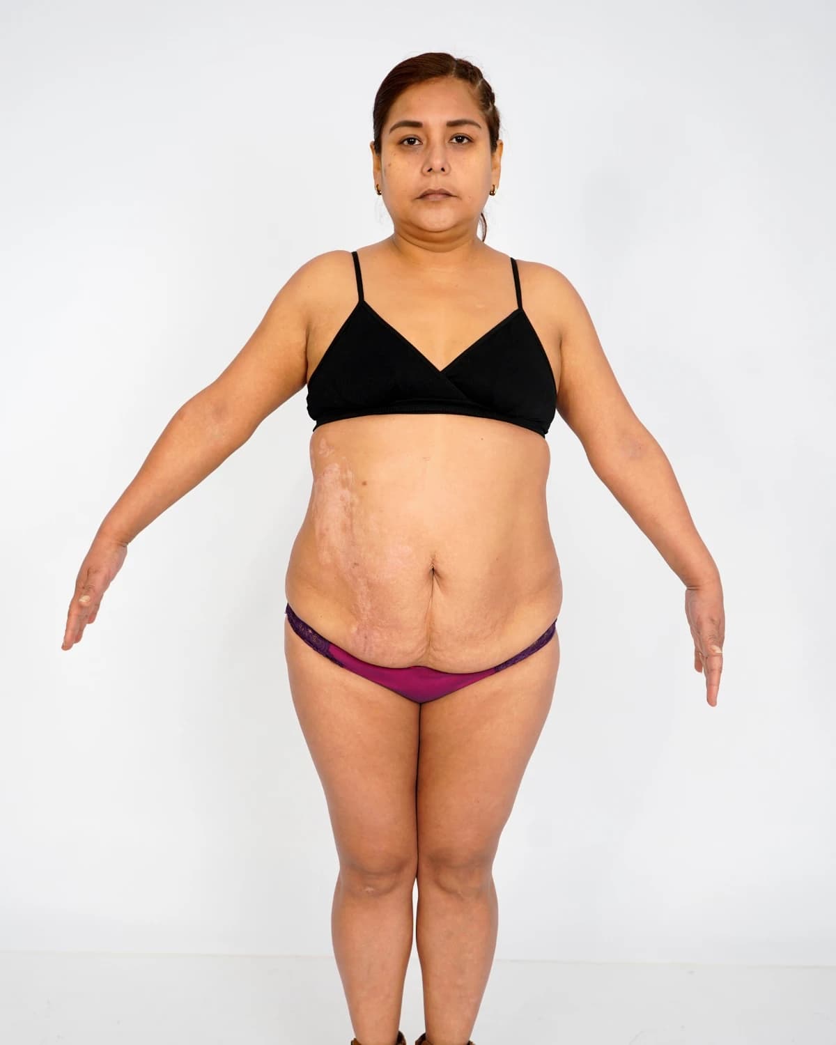 Mommy Makeover, case 2: front view of the abdomen and bust before surgery, patient in a black bra on a light background