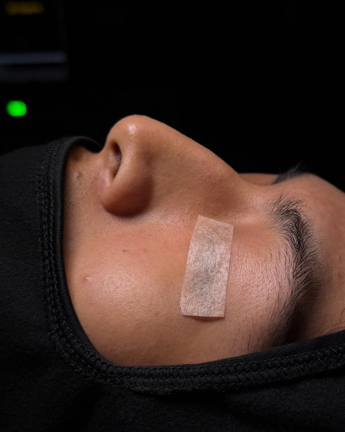 Clinical rhinoplasty photograph before the procedure: patient lying down, side view of the nose