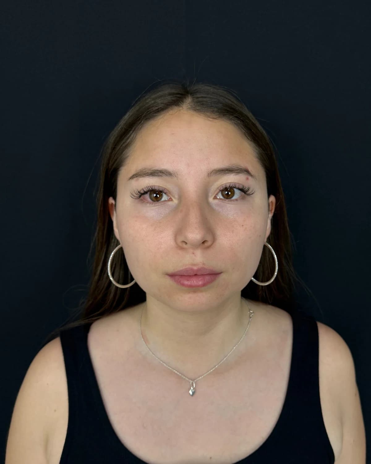 Rhinoplasty, case 2: front view of the patient's face and nose, wearing a black strappy top on a dark background