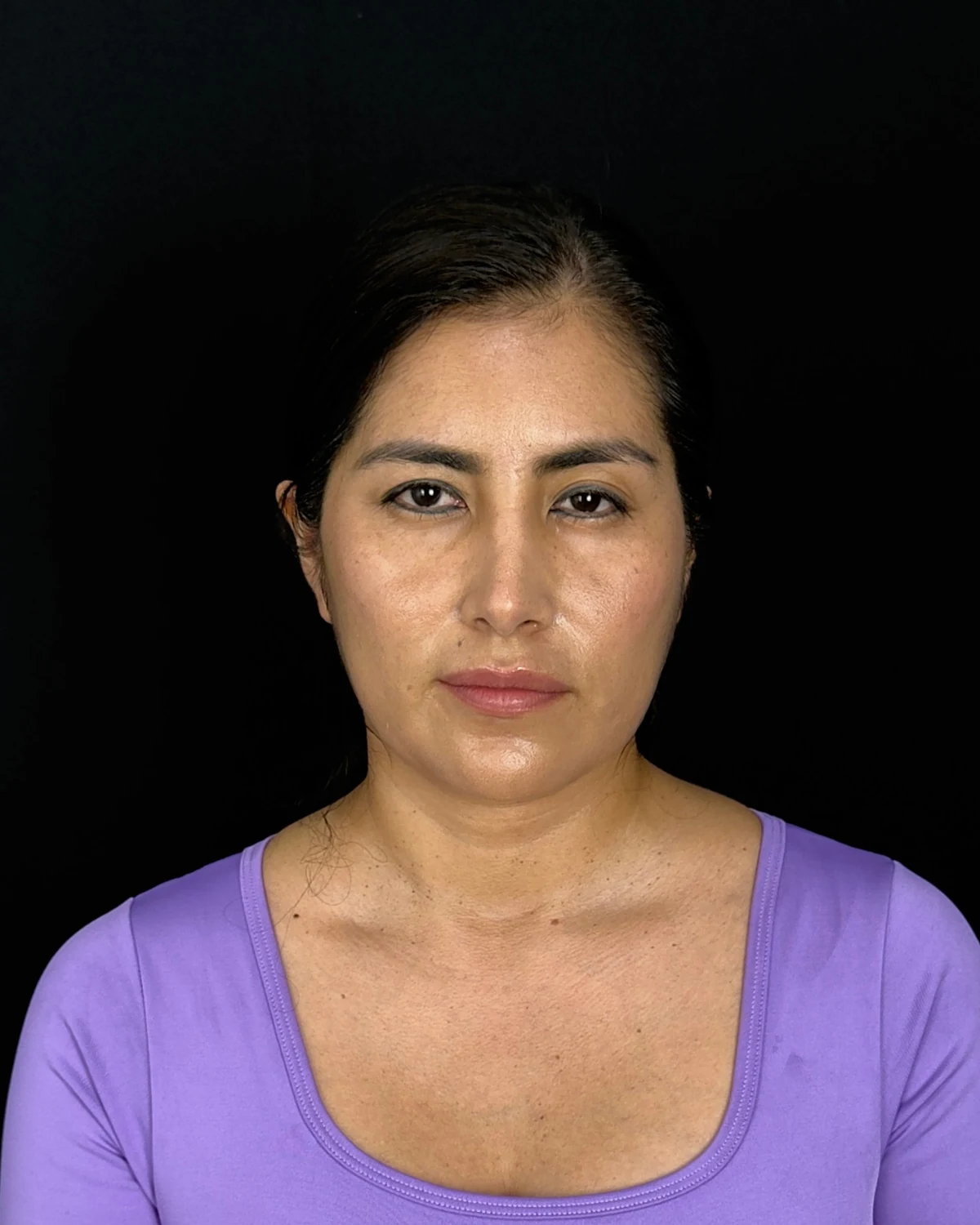 Paciente de frente antes del lifting endoscópico, con blusa morada sobre fondo oscuro