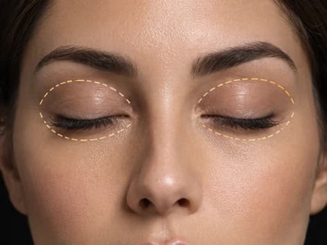 Blefaroplastia en Lima: marcación de párpados superiores e inferiores para rejuvenecer la mirada con el Dr. Freddy Castillo