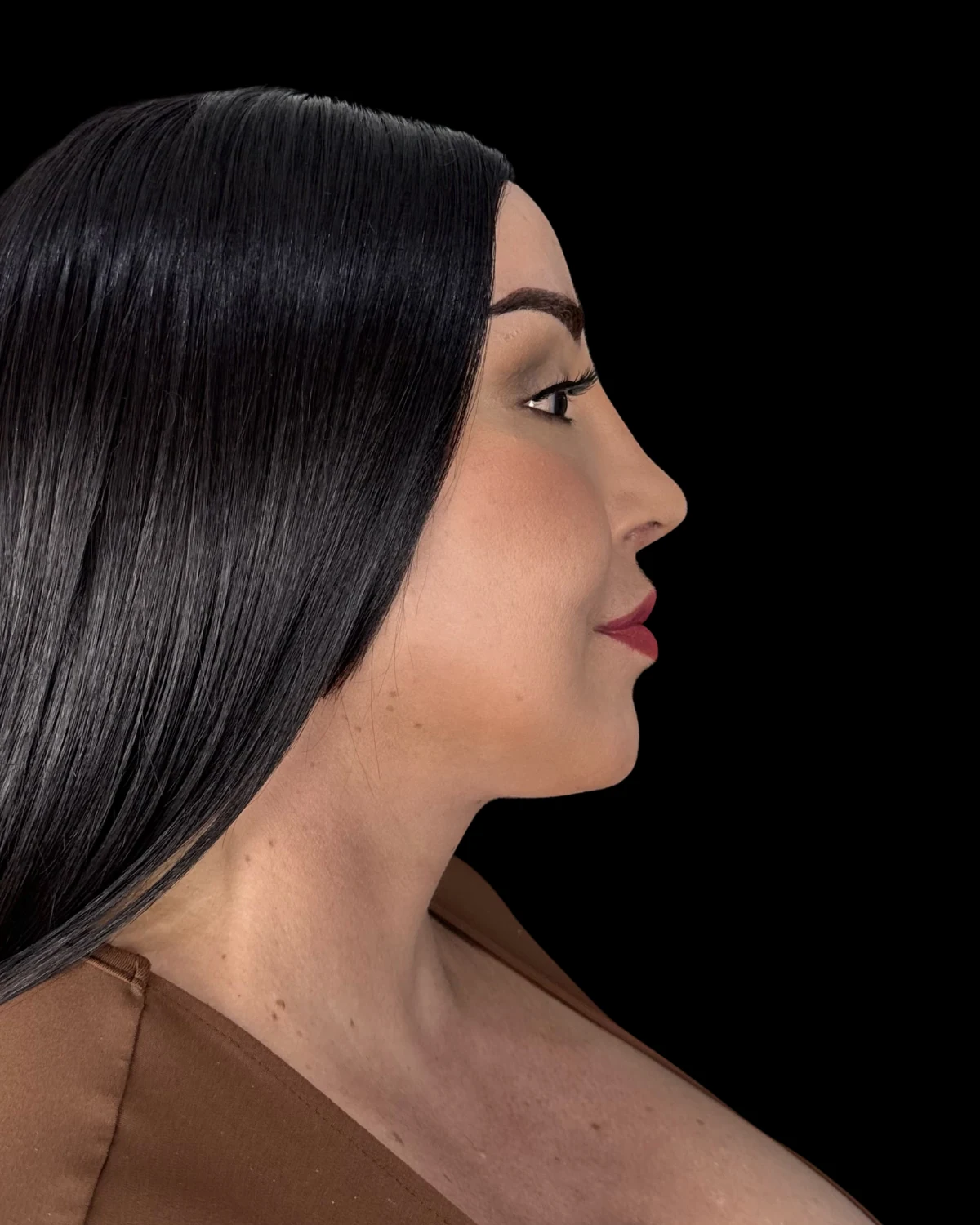 Perfil facial después del procedimiento de lifting Deep Plane