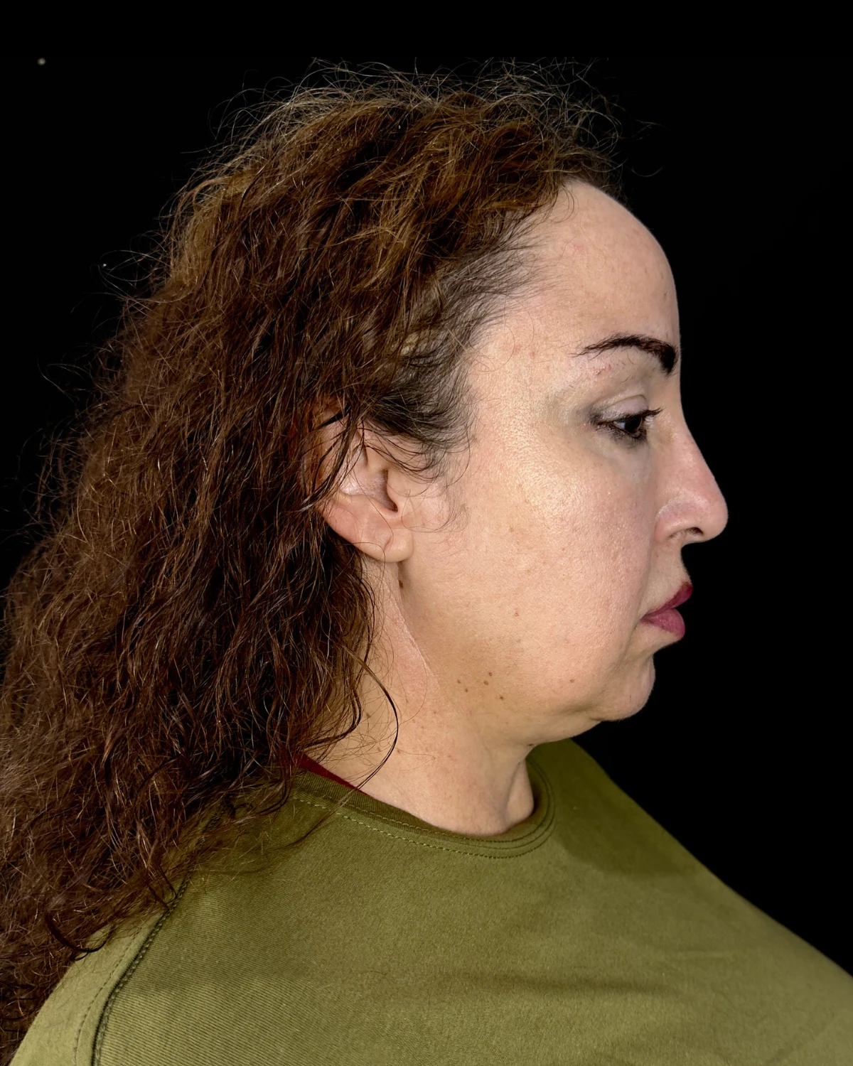 Perfil facial antes del procedimiento de lifting Deep Plane