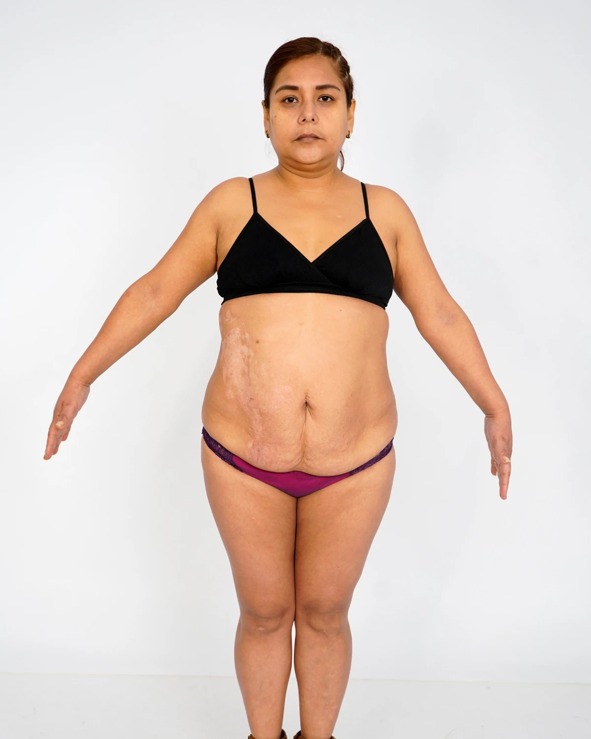 Mommy Makeover, caso 2: vista frontal del abdomen y el busto antes de la cirugía, paciente con sujetador negro sobre fondo claro