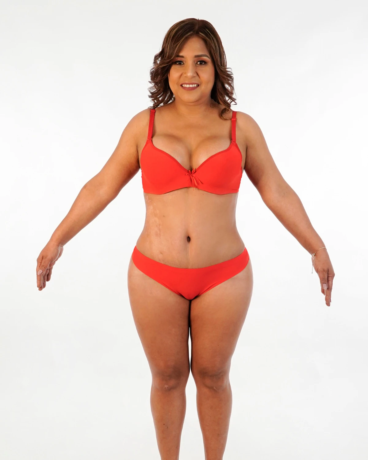 Mommy Makeover, caso 2: vista frontal de la misma paciente después de la cirugía, con conjunto rojo sobre fondo claro