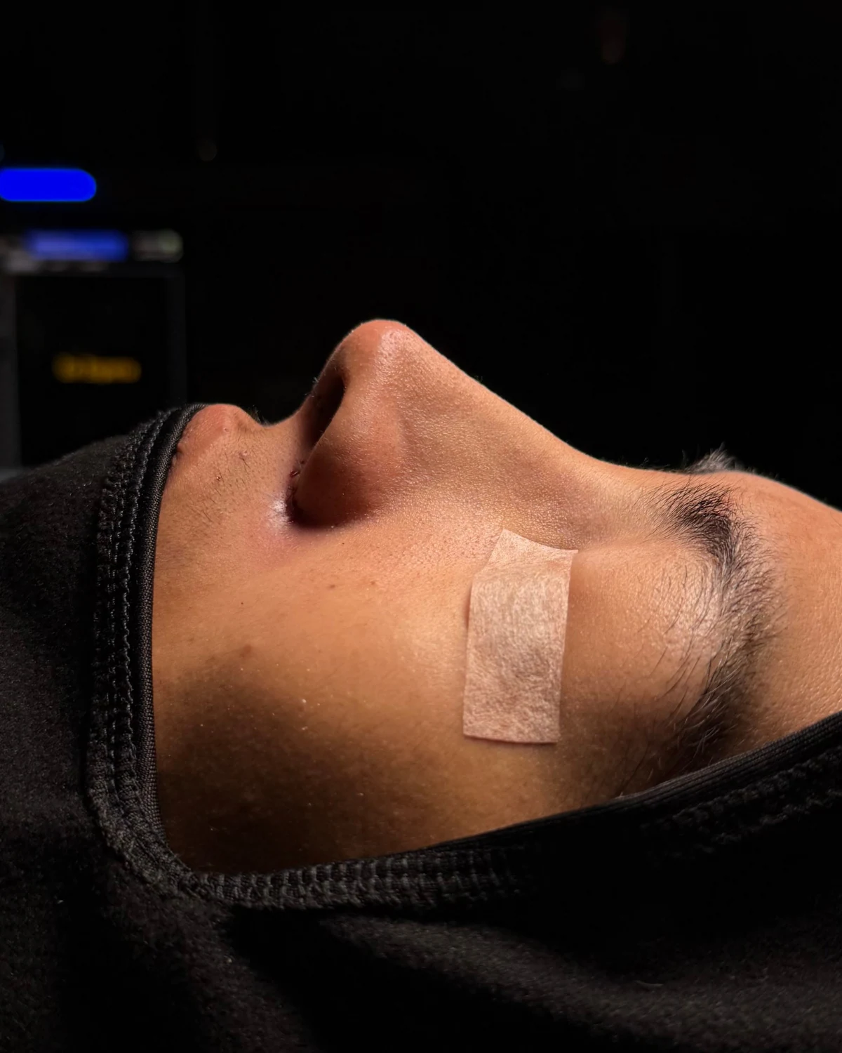 Fotografía clínica de rinoplastia después del procedimiento: paciente recostada, vista lateral de la nariz