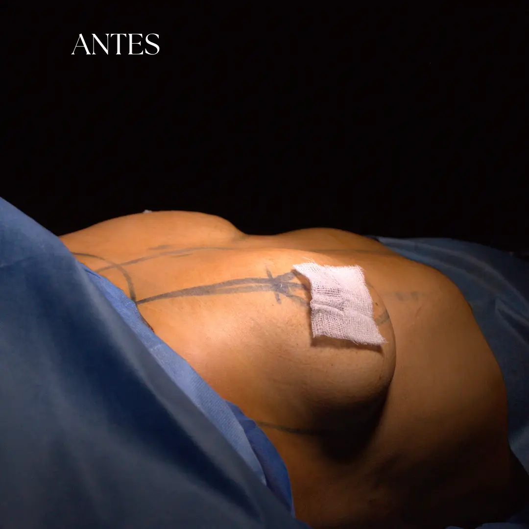 Antes de mamoplastia en Lima evaluada por el Dr Freddy Castillo