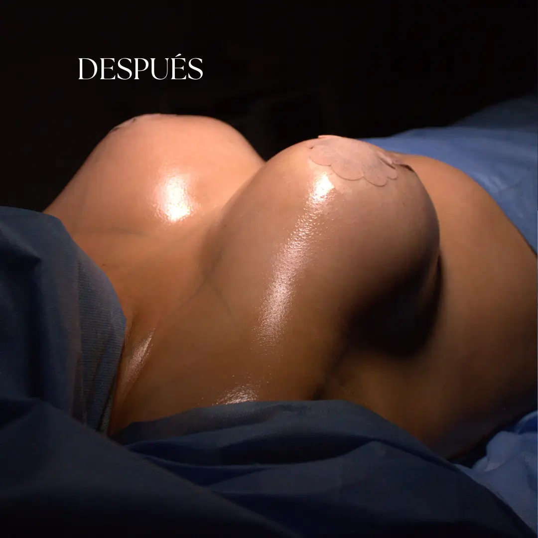 Después de mamoplastia en Lima realizada por el Dr Freddy Castillo con resultado proporcional y natural